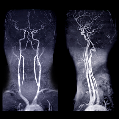 Carotid Angiogram / Angioplasty