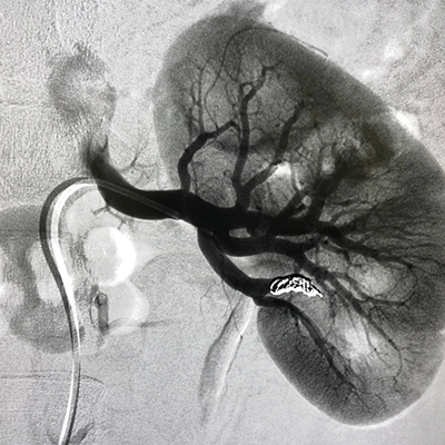 Renal Angiogram / Angioplasty